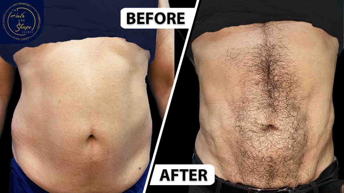 Liposuction result6